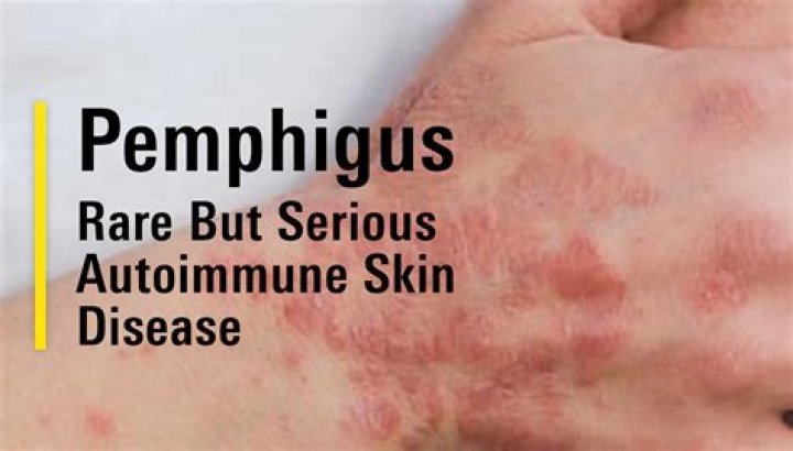 What is Pemphigus