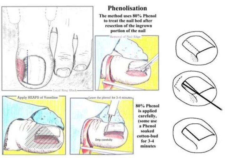 What is Phenolization