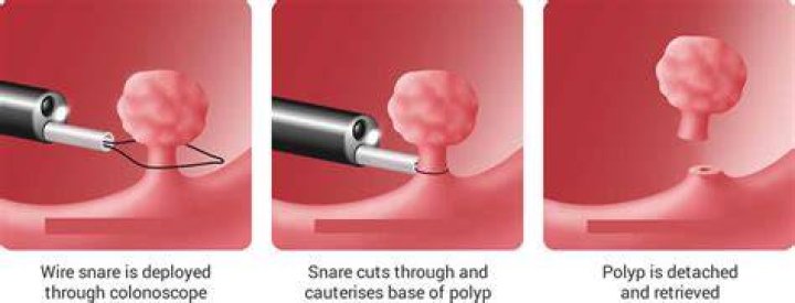 What is polypectomy