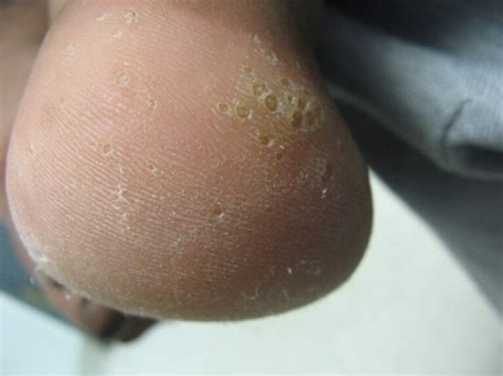 What is punctate Keratoderma