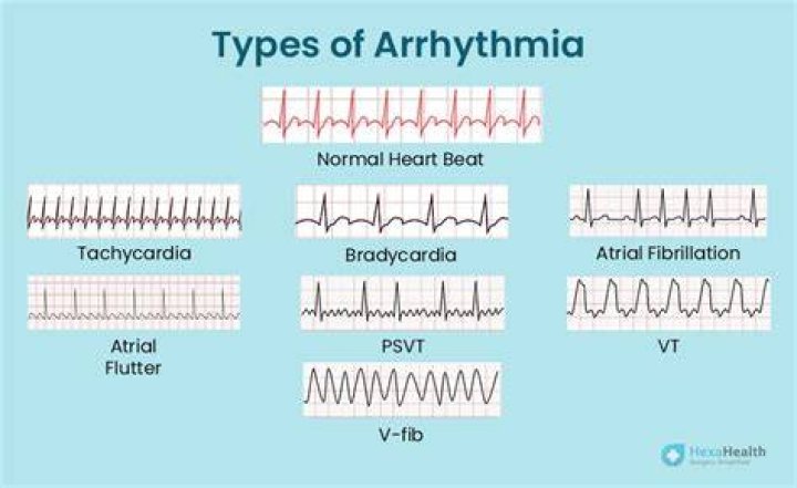 What is the difference between dysrhythmia and arrhythmia