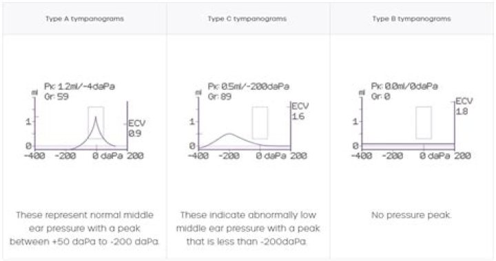 What is Tympanometry compliance