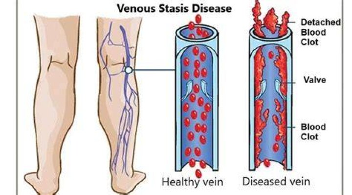 What is venous stasis