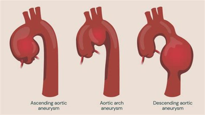 What problems can an enlarged aorta cause?