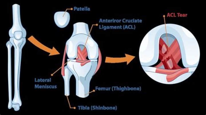 Where does the ACL originate and insert