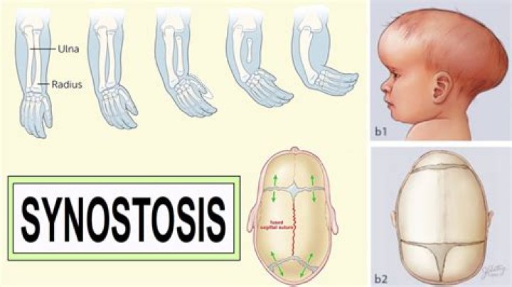 Where is Synostosis found
