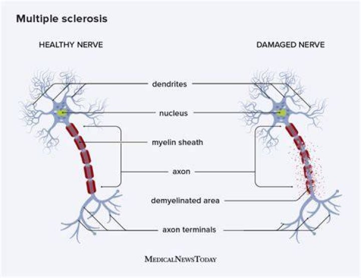 Which pathophysiologic mechanism is associated with multiple sclerosis?
