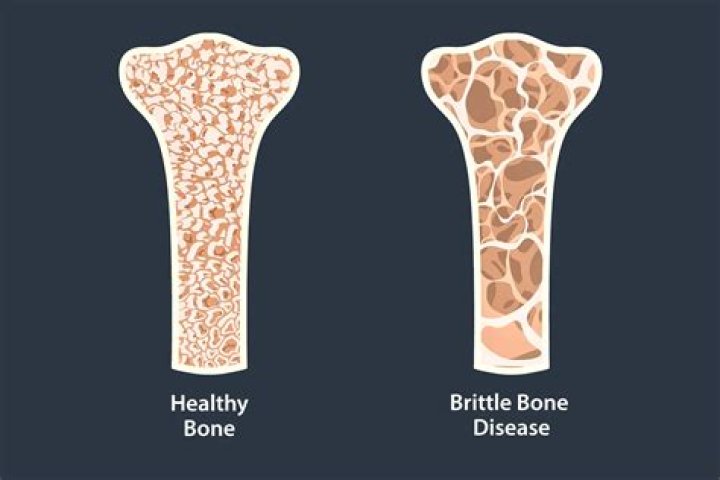 Why do bones become brittle when baked?